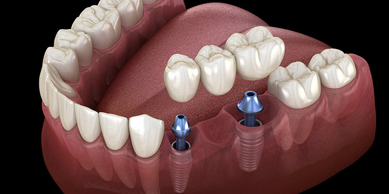 Cấy Ghép Implant Là Gì?