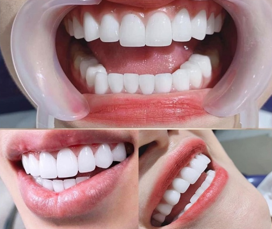 Bọc Răng Sứ Thẩm Mỹ Khi Nào Nên Thực Hiện
