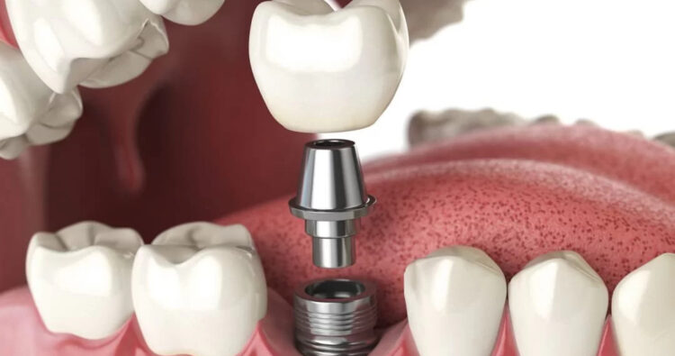 Cấy Ghép Răng Implant Là Gì?