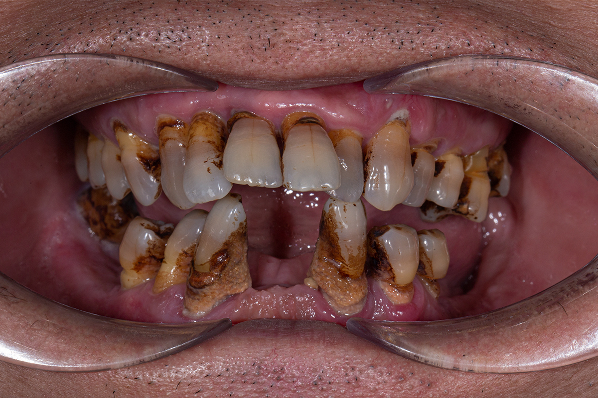 </center>Công thức tính chi phí trồng răng</center>