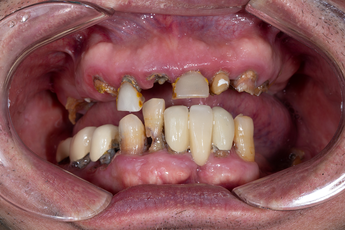 <center>Mất Răng Lâu Năm Kết Hợp Bệnh Lý Nền Khiến Tiêu Xương Tụt Lợi Nặng</center>