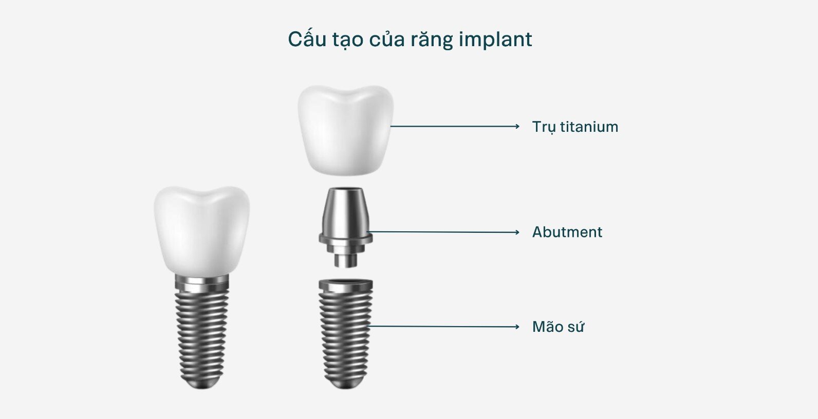 <center>Chi phí trộng răng trọn gói răng Implant hoàn chỉnh phải có giá của cả 3 bộ phận</center>