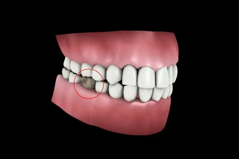 Răng 5 Đóng Vai Trò Hỗ Trợ Chức Năng Nhai