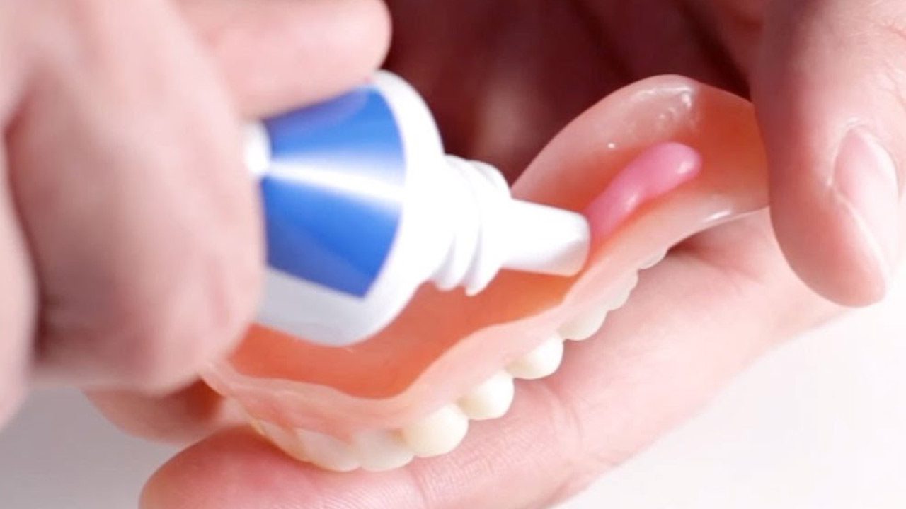 Cần keo dán hàm giả tháo lắp sau một thời gian sử dụng