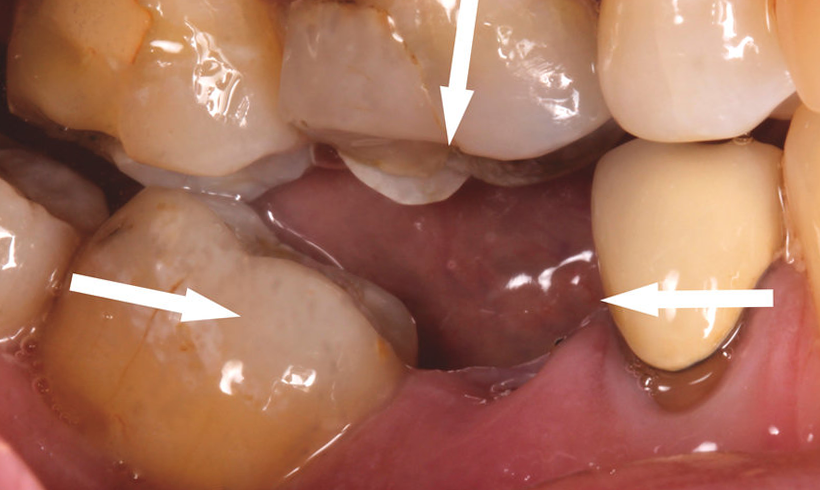 Hậu quả mất răng 5 lâu ngày gây xô lệch các răng còn lại trong cung hàm, khó khăn ăn nhai