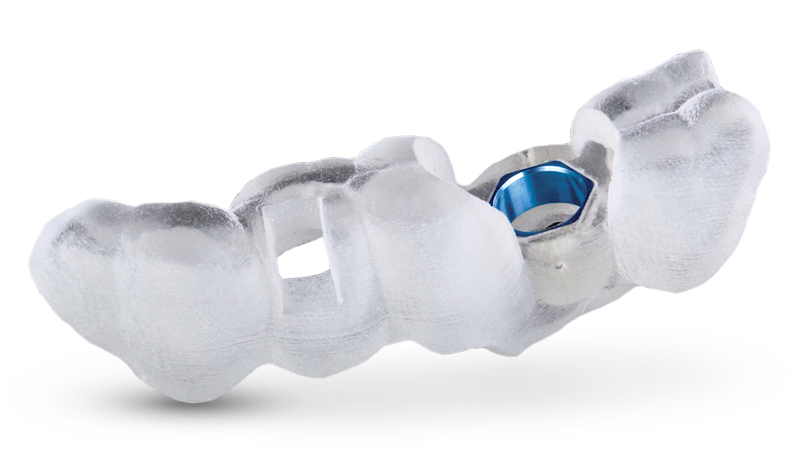 Trồng răng bằng máng hướng dẫn phẫu thuật cho kết quả an toàn, chính xác, bền vững