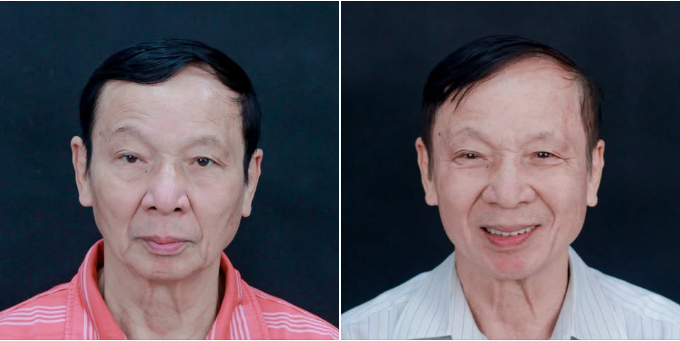 Sự thay đổi của bệnh nhân 79 tuổi sau trồng răng Implant toàn hàm