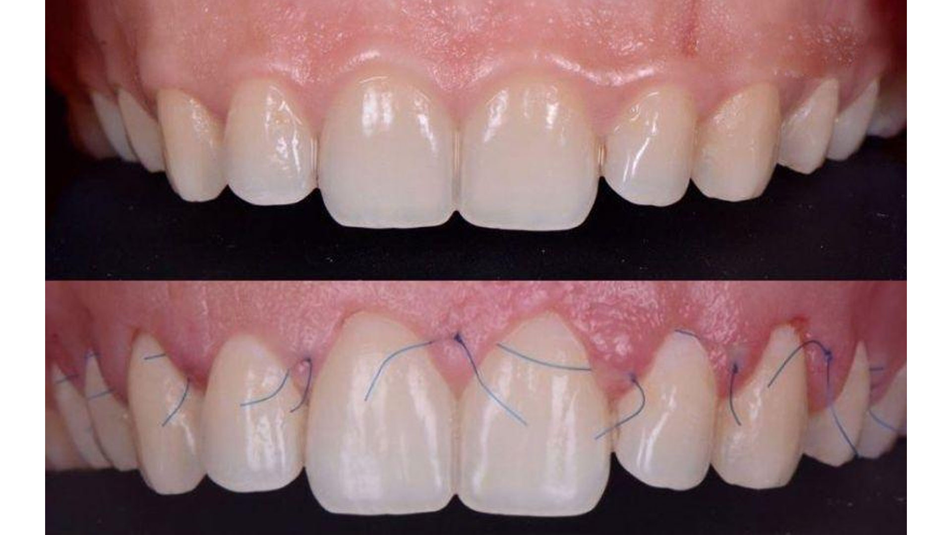Chỉ chậm tiêu dùng cho cắt lợi