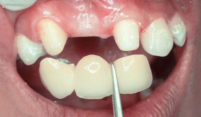 Làm cầu răng sứ có thể ăn nhai tốt không?