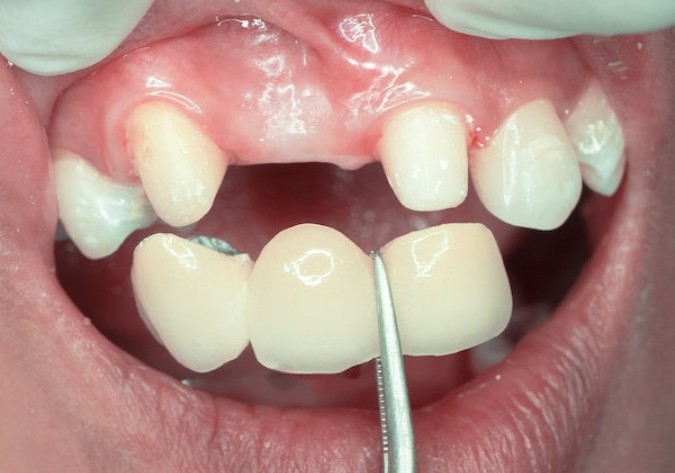 Làm cầu răng sứ có thể ăn nhai tốt không?