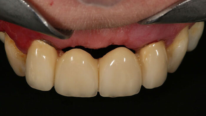 Cầu răng sứ – phục hình cố định nhưng xâm lấn