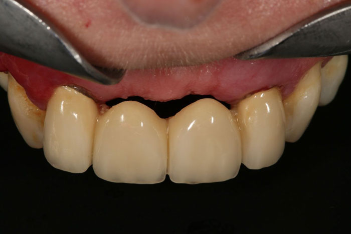 Cầu răng sứ – phục hình cố định nhưng xâm lấn