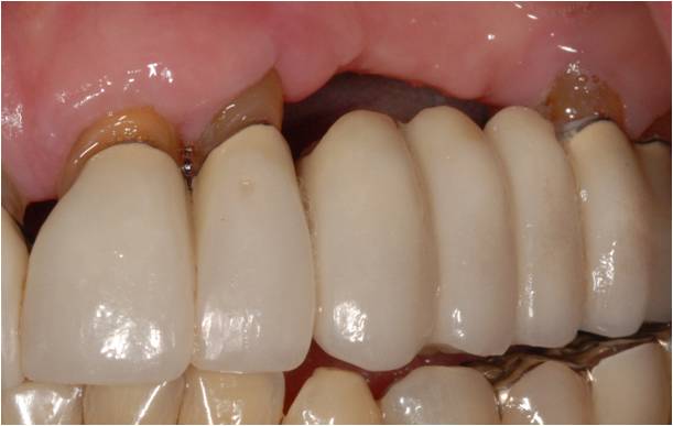 Bọc Răng Sứ Có Thay Thế Được Răng Mất Không?