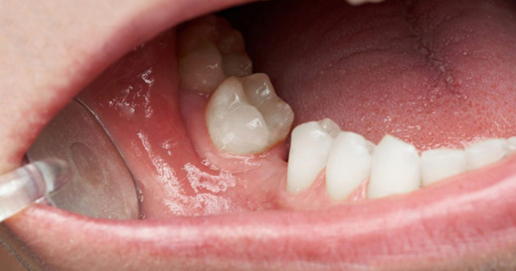 Mất răng lâu năm, xương đã tiêu nhiều
