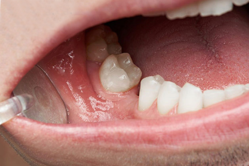 Mất răng lâu năm, xương đã tiêu nhiều