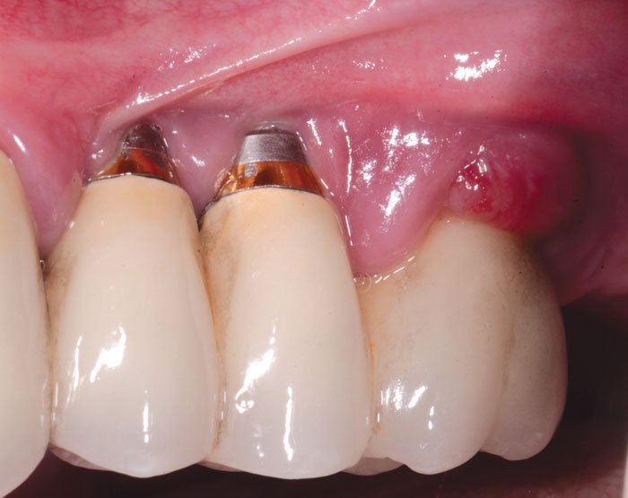 Dấu hiệu viêm quanh trụ Implant nếu mô mềm bị thiếu độ dày