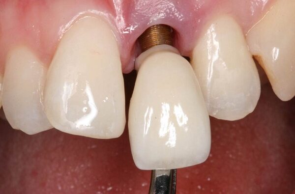 Mô mềm xunh quanh Implant là hàng rào bảo vệ