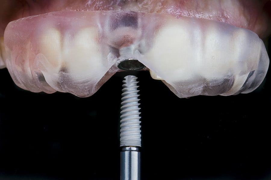 Mướng Hướng Dẫn Phẫu Thuật Trong Cấy Ghép Implant Giảm Xâm Lấn Mô Mềm