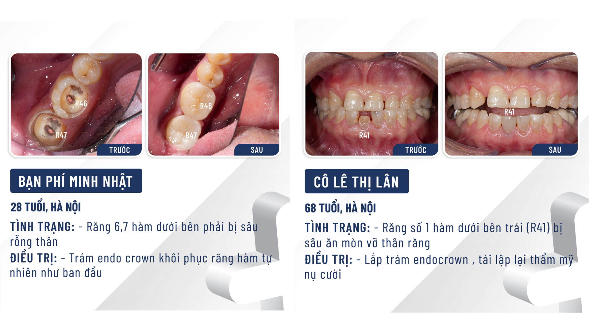 Phục hình endocrown