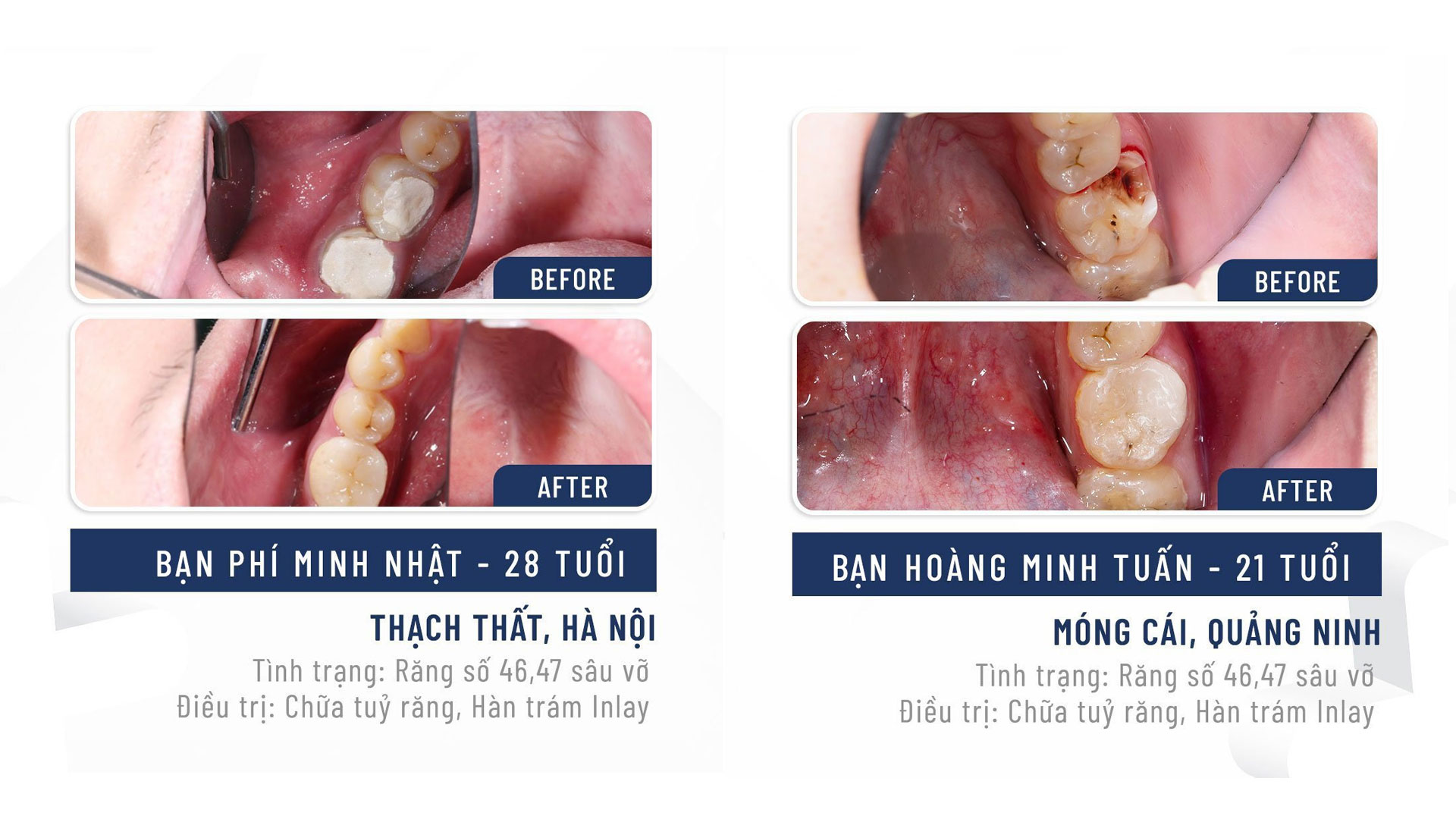 Phục hình Inlay