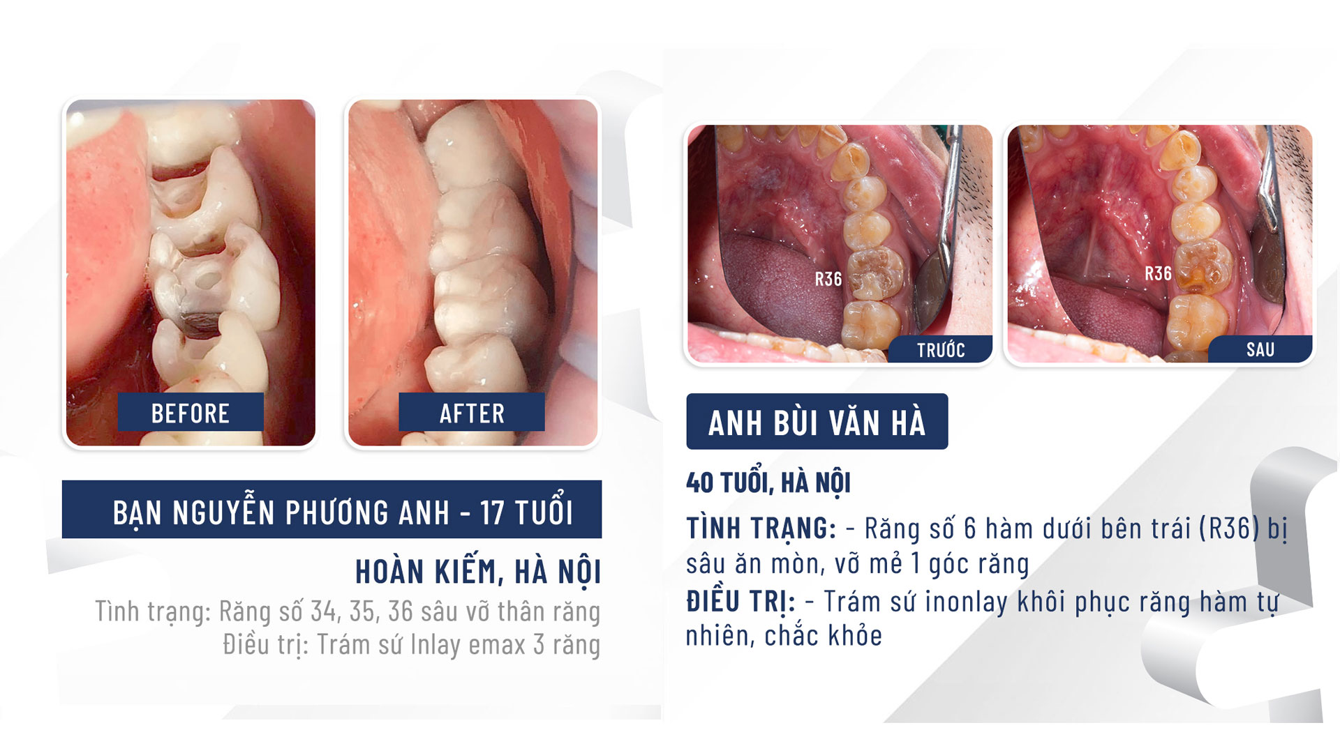 Phục hình Onlay