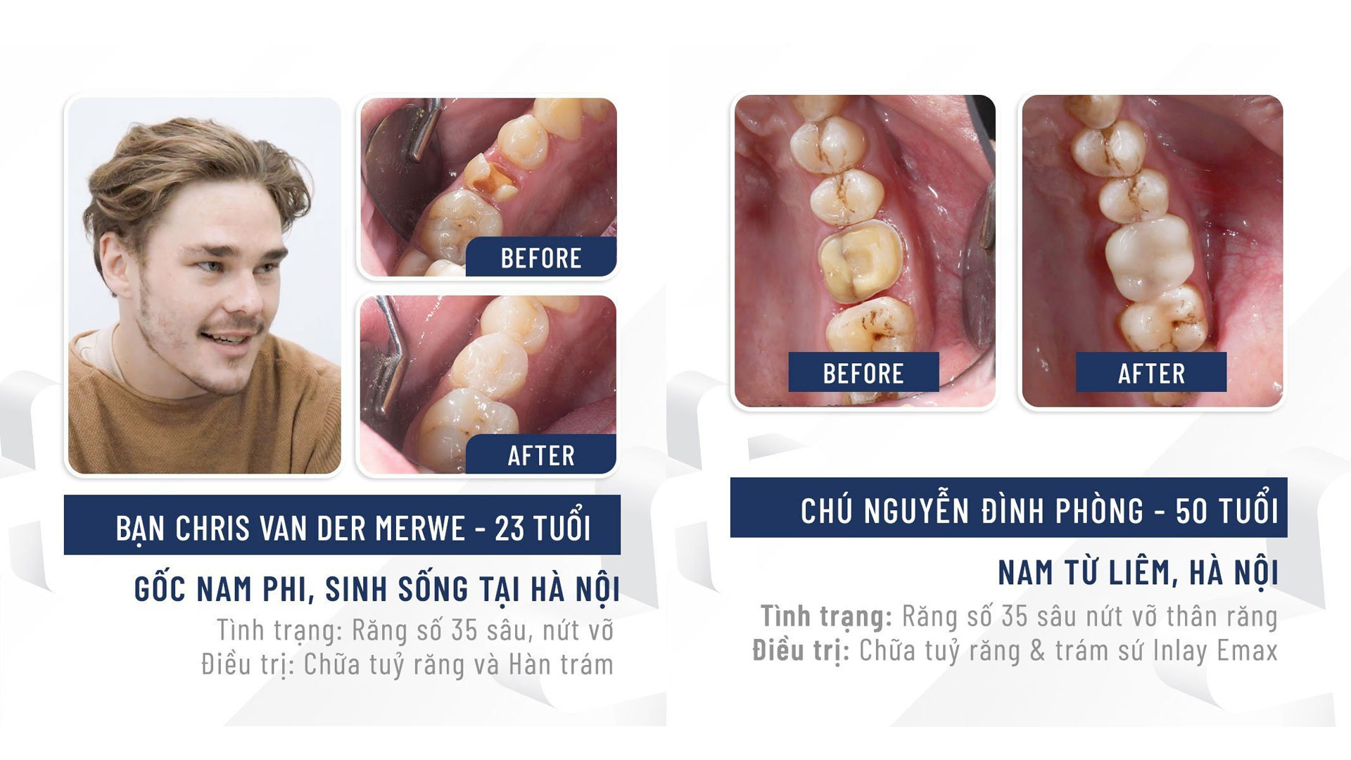 Phục hình Overlay