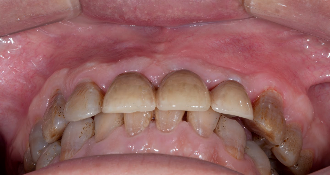 Nhìn vào đây thì bạn biết đâu là răng giả Implant không