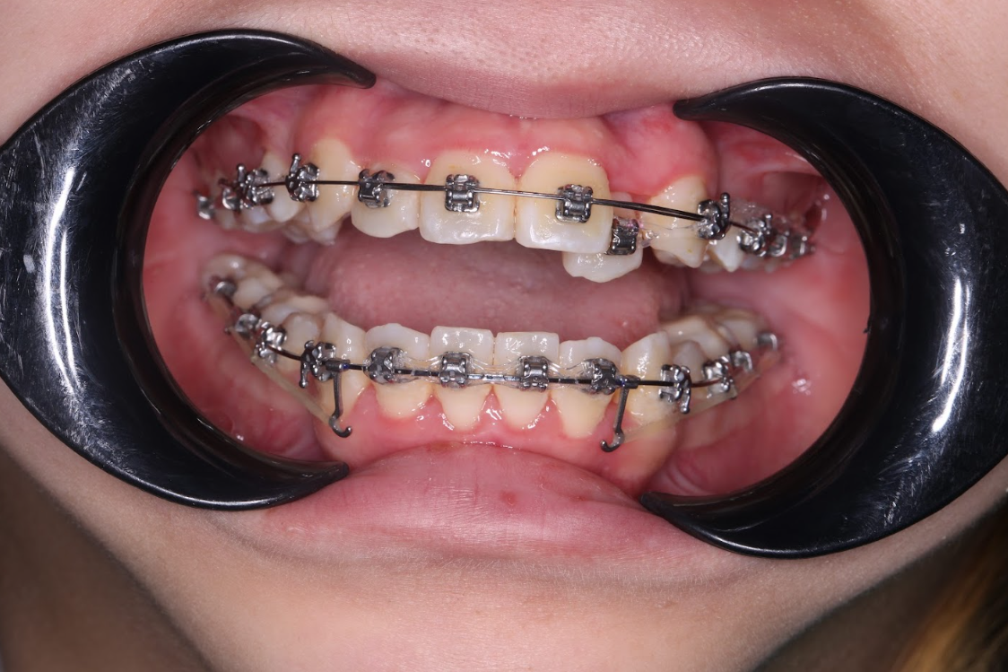 Niềng Răng Mắc Cài Kim Loại