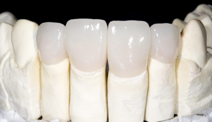 Thẩm mỹ răng sứ chỉ được chỉ định khi thật sự cần thiết