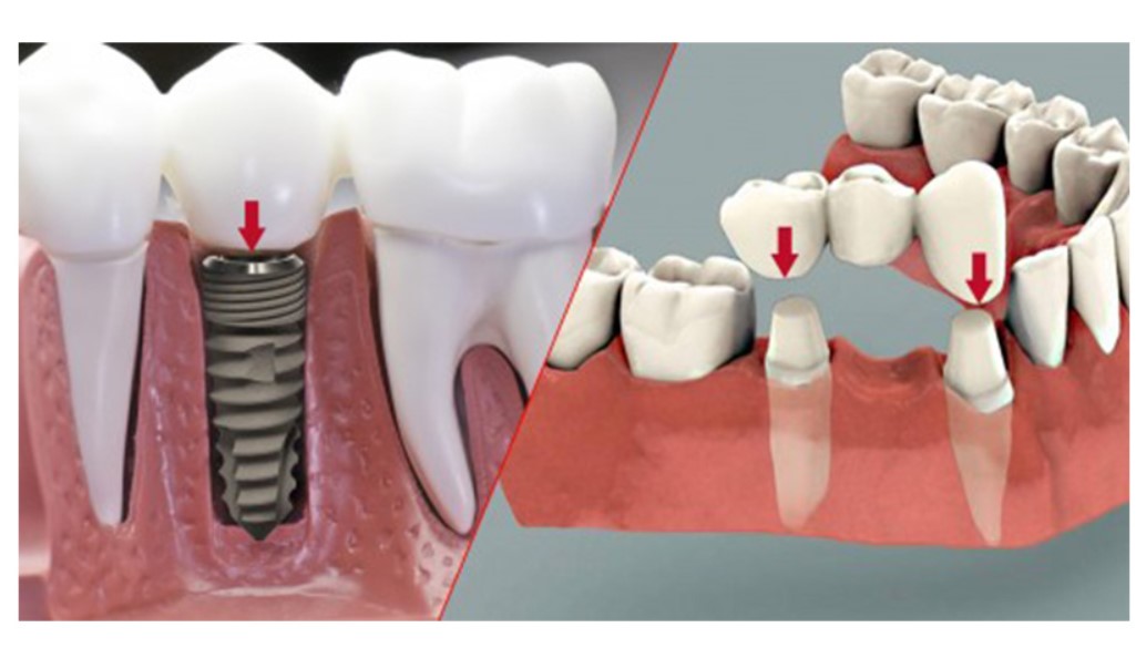 So sánh làm Implant và Cầu Răng Sứ Cái Nào Tốt Hơn