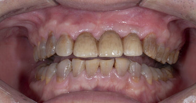 Trồng răng Implant càng sớm hình thể răng càng giống răng thật ban đầu