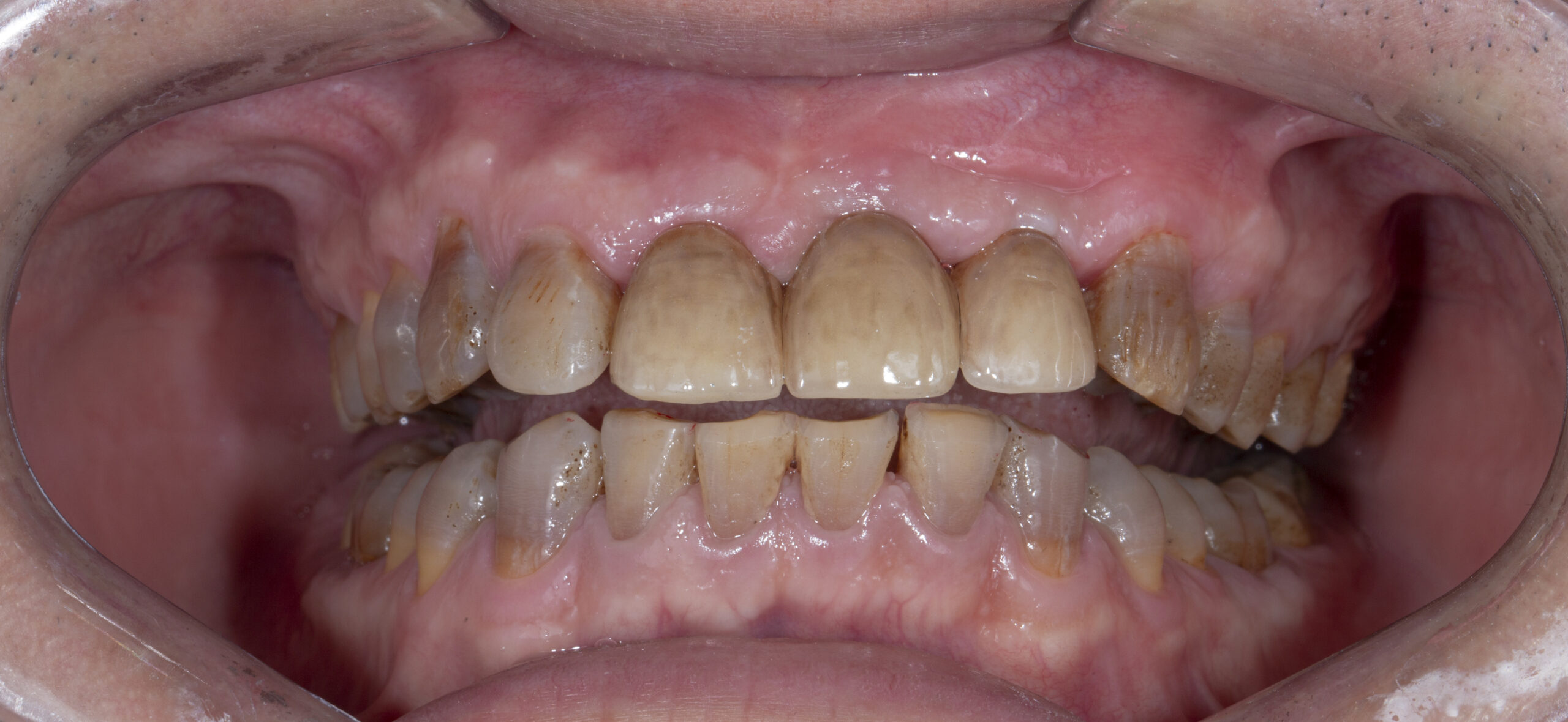 Trồng răng Implant càng sớm hình thể răng càng giống răng thật ban đầu