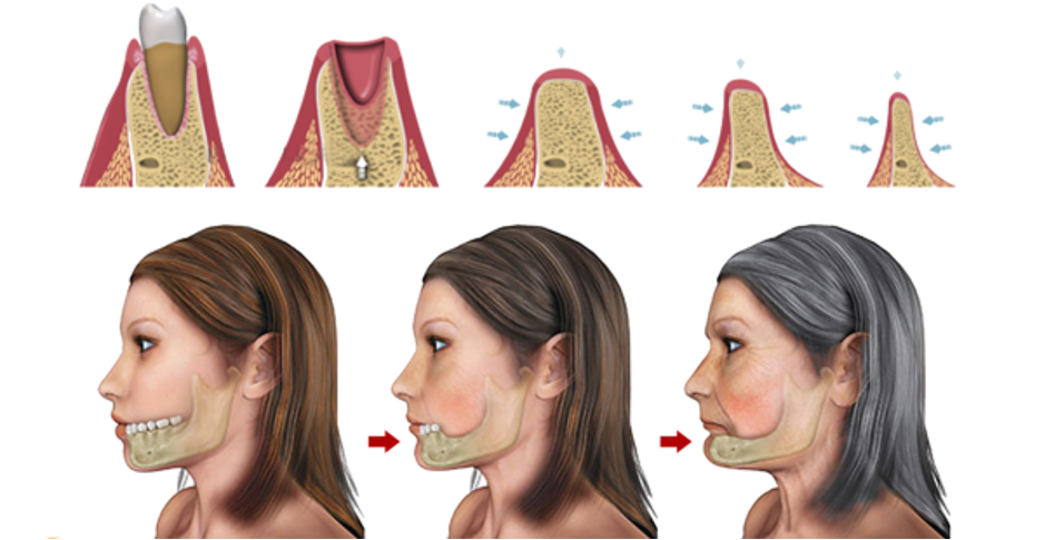 Tại sao mất răng trồng Implant càng sớm thì càng tránh được việc tiêu xương hàm