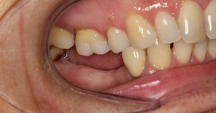 Mất răng không đơn giản là mất đi một chiếc răng