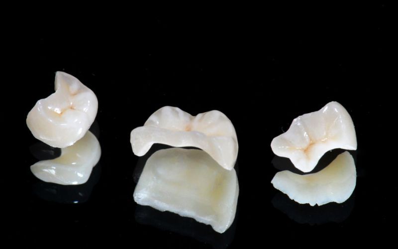 Inlay/Onlay/Endocrown là gì?