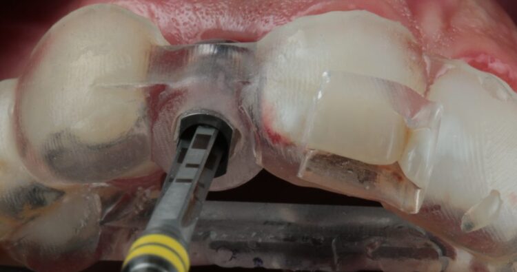 Trồng răng bằng máng hướng dẫn phẫu thuật