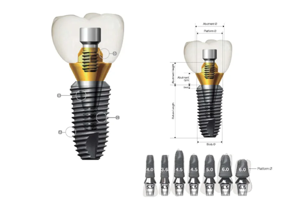 Chất liệu cấu tạo trụ Implant Dentium