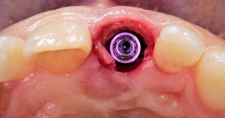 Trụ Implant vừa được đặt vào xương hàm