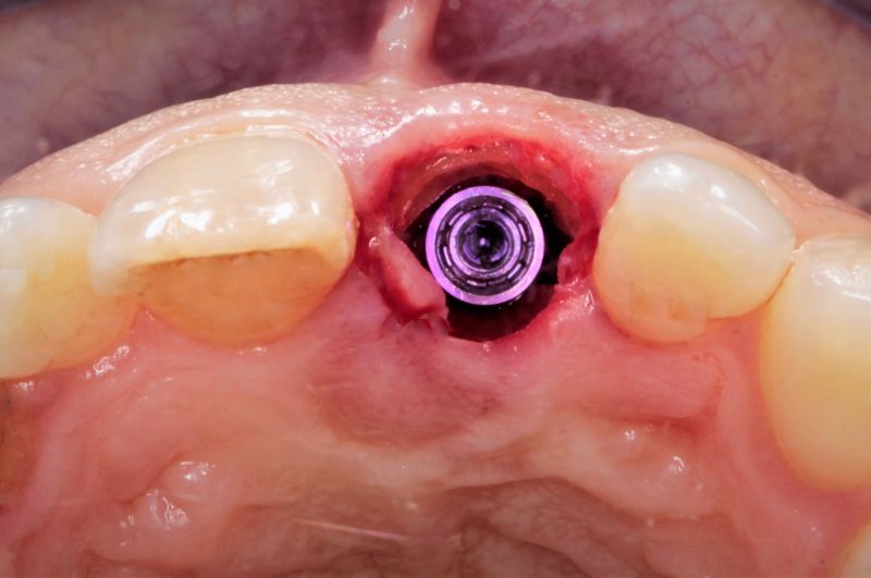 Trụ Implant vừa được đặt vào xương hàm