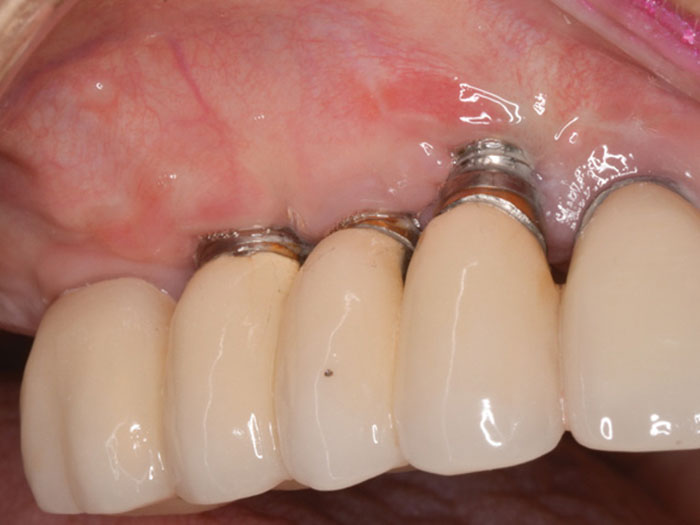 Viêm quanh răng Implant là biến chứng khó sửa chữa