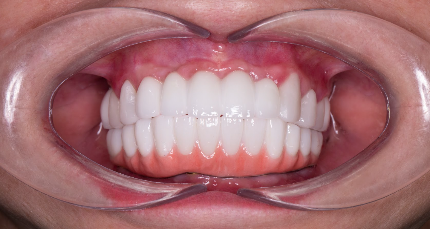 Trồng răng – và hành trình lấy lại thanh xuân