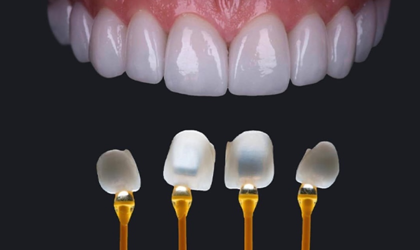 Răng sứ giá rẻ là gì? Vì sao thu hút nhiều người?