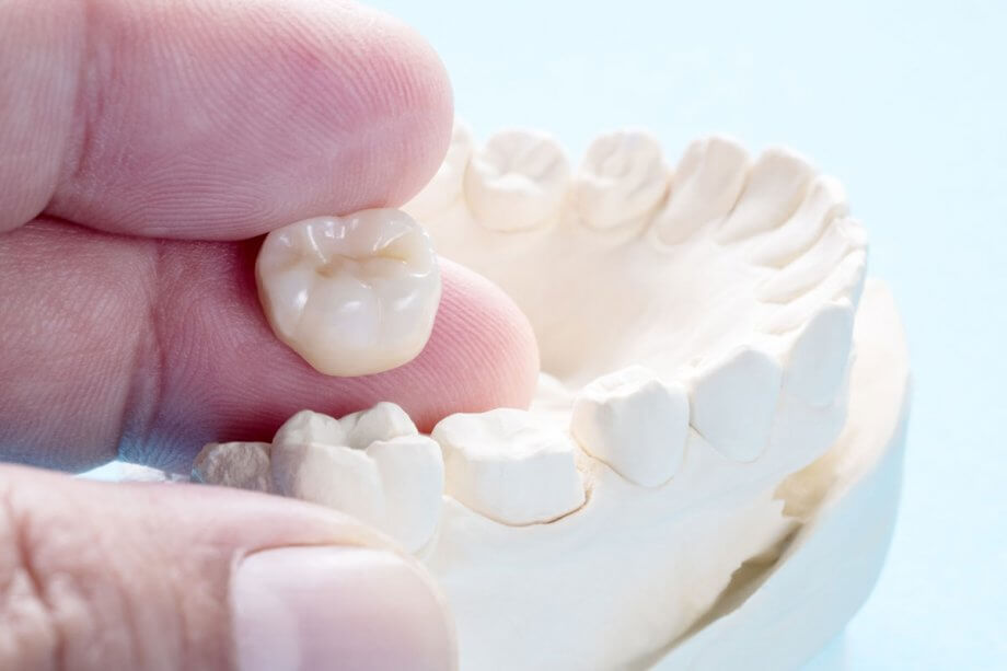 Lợi ích của quy trình bọc răng sứ không đau