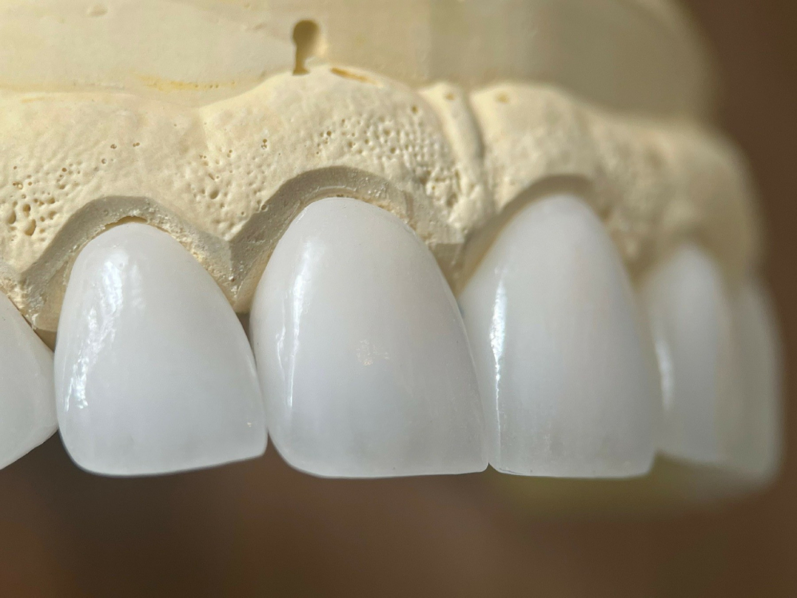 Chuyên gia nói gì? – Khi nào nên làm răng sứ và chọn loại nào?