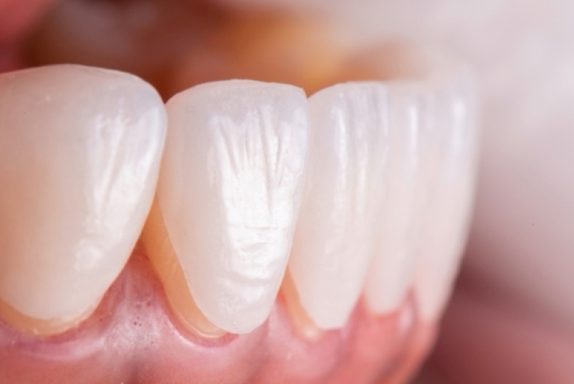 Răng sứ bọc toàn sứ không gây đen viền nướu