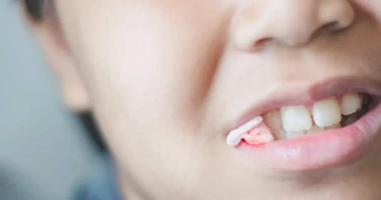 Cách chăm sóc sau nhổ răng khôn ban đêm bác sĩ khuyên dùng