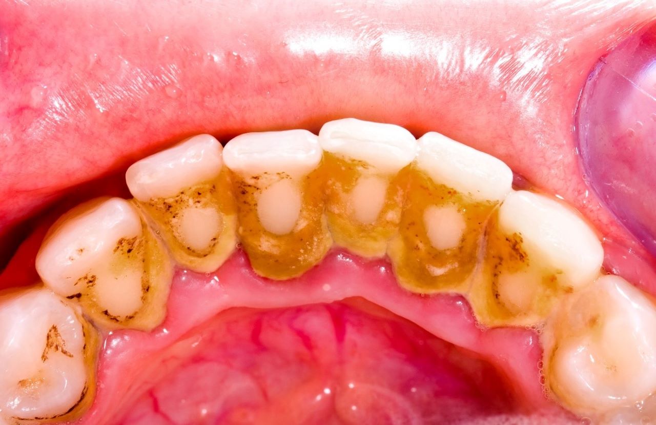Vì sao cạo vôi răng lại quan trọng?
