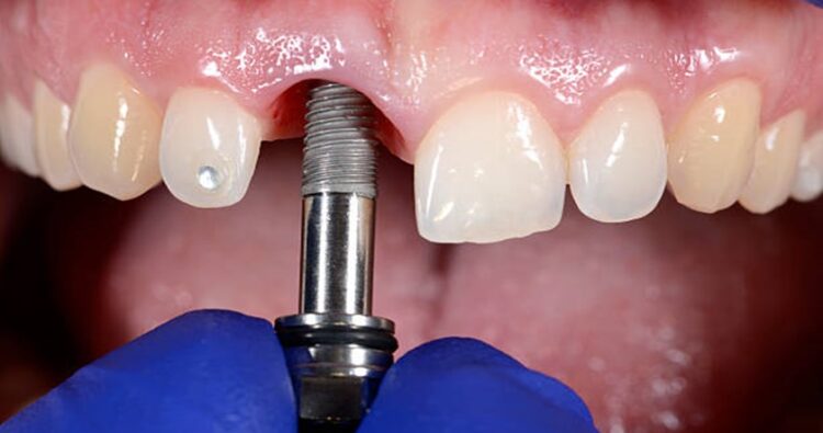 Khi nào thì nên sử dụng thay thế răng mất bằng Implant