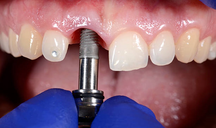 Khi nào thì nên sử dụng thay thế răng mất bằng Implant