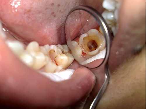 Dấu hiệu răng sữa cần điều trị tủy